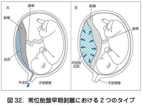 胎盤形成出血|【医師監修】妊娠中 の胎盤の役割は？胎盤の異常で。